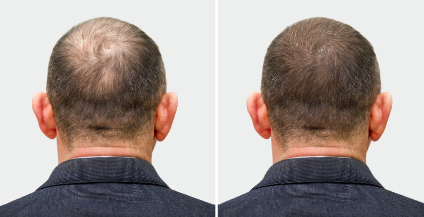 Hair Regrowth Oil & Shampoo